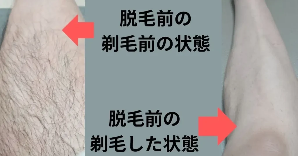 すね下エリアの最初の状態と照射前の剃毛した状態の写真