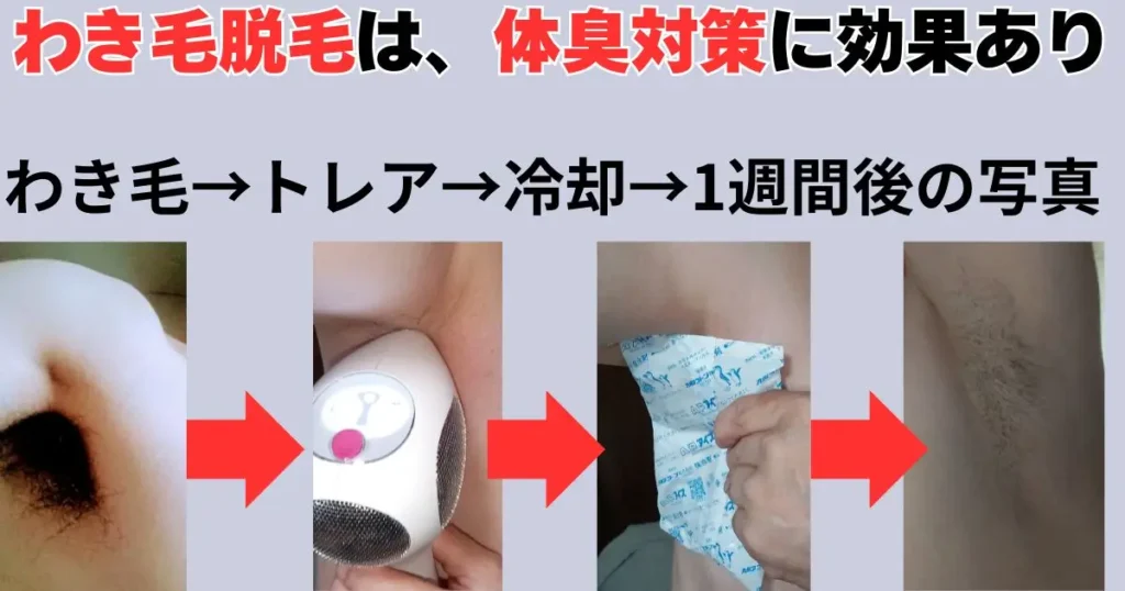 わき毛脱毛の手順写真
体臭対策に効果あり