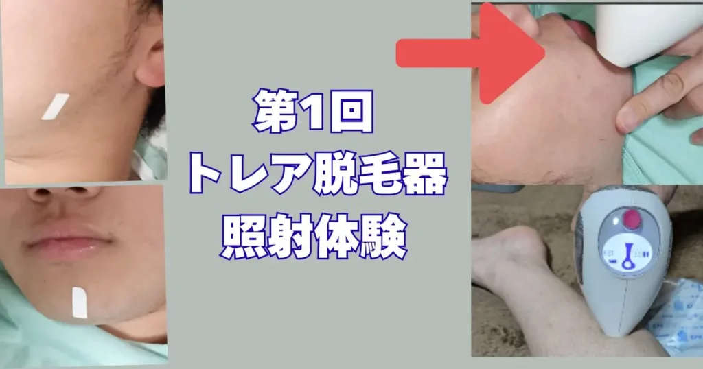トレア脱毛器の照射体験
からの注意事項についての記事の図解
ホクロに白テープを貼った写真いり図解