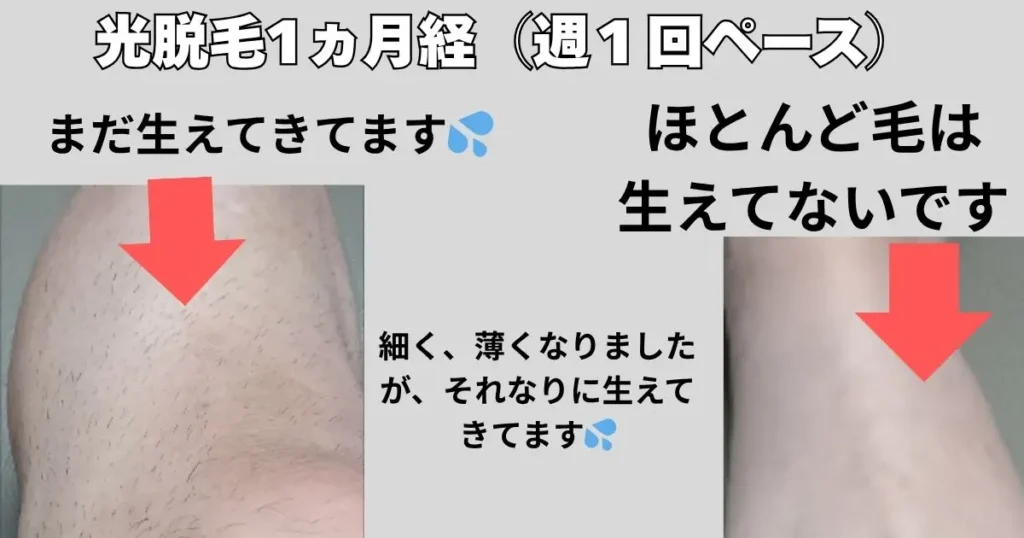光脱毛したひざ下エリアの結果報告の写真いり図解