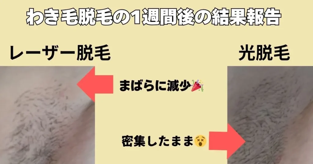 わき毛脱毛のレーザーと光脱毛の結果報告(1回目7日後)比較した写真いり図解
