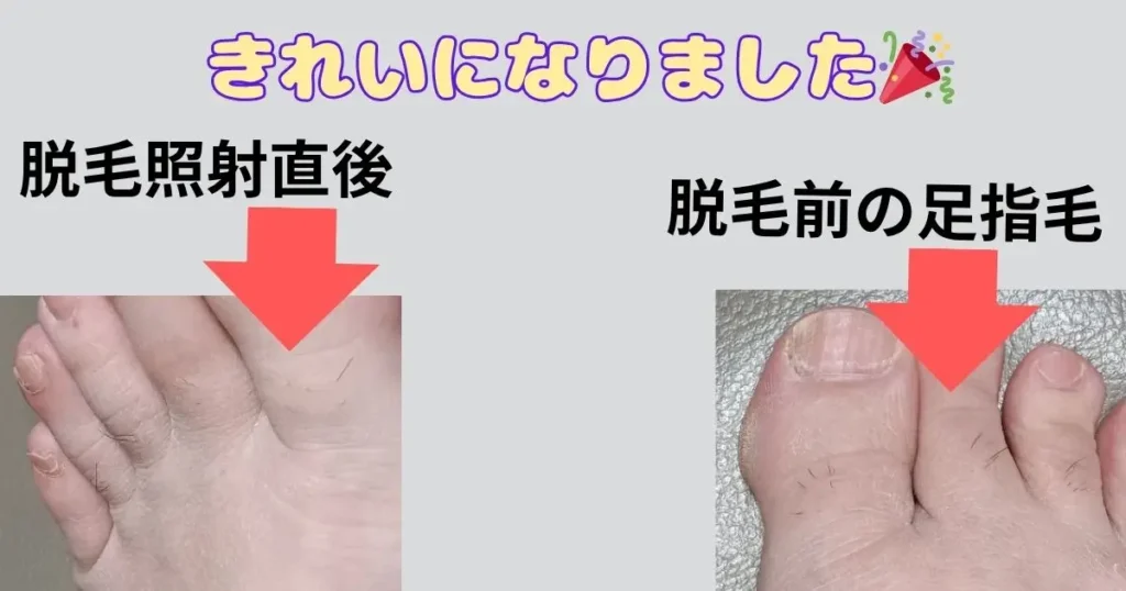 足指毛のセルフ脱毛の写真図解