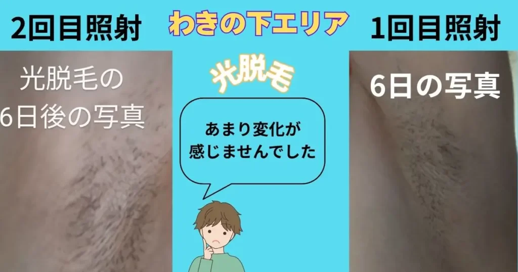 光脱毛1回目と2回目照射後6日経過した脇の毛の比較画像 ほとんど変化なし