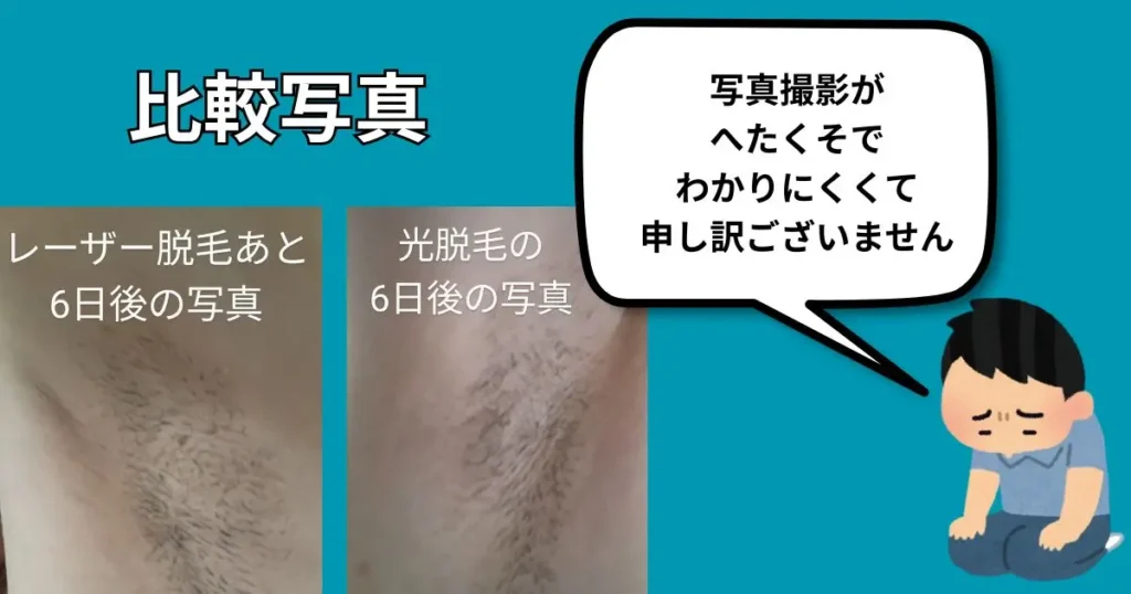 レーザー脱毛と光脱毛 6日目のわき毛の比較画像