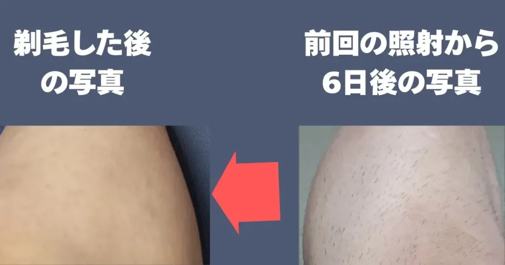 毛を剃った直後の足と脱毛後6日経って毛が少し生えた足