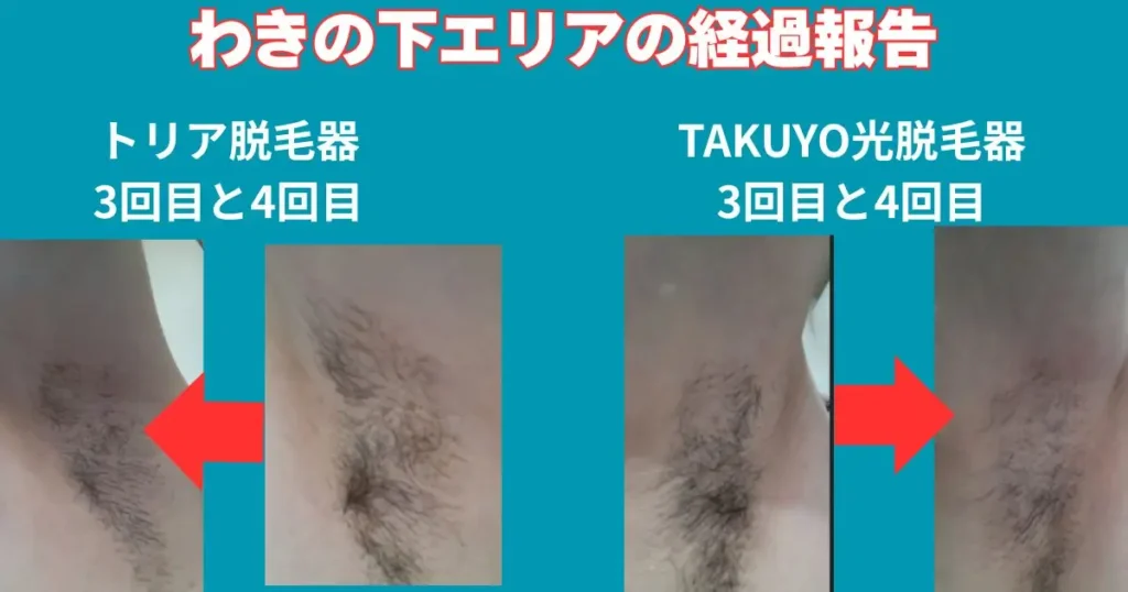 わき毛脱毛の経過報告写真。
トリアレーザー脱毛とTAKUYO光脱毛の比較写真。
さらに3回目と4回目も比較できるようにしました。