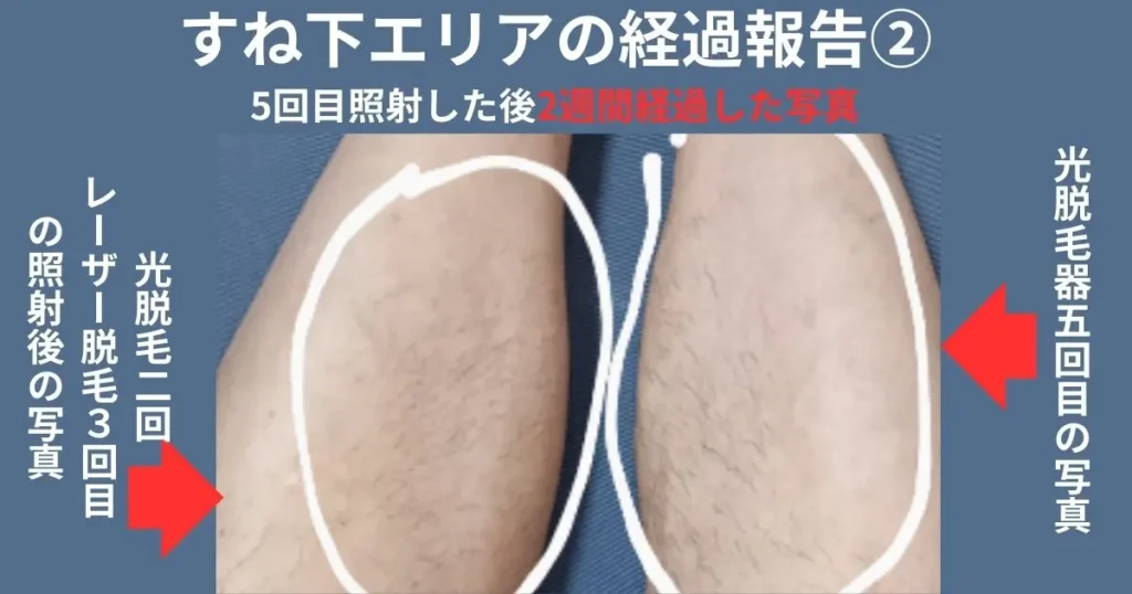セルフ脱毛のひざ下エリアの左右比較写真です。
右足は、光脱毛のみ
左足は、光脱毛2回・レーザー脱毛3回の照射後の写真。
2週間放置した写真。
光脱毛のみの右足は濃くて長い毛が多い。
レーザー脱毛を追加した左足は、色が薄く細い毛が多い。