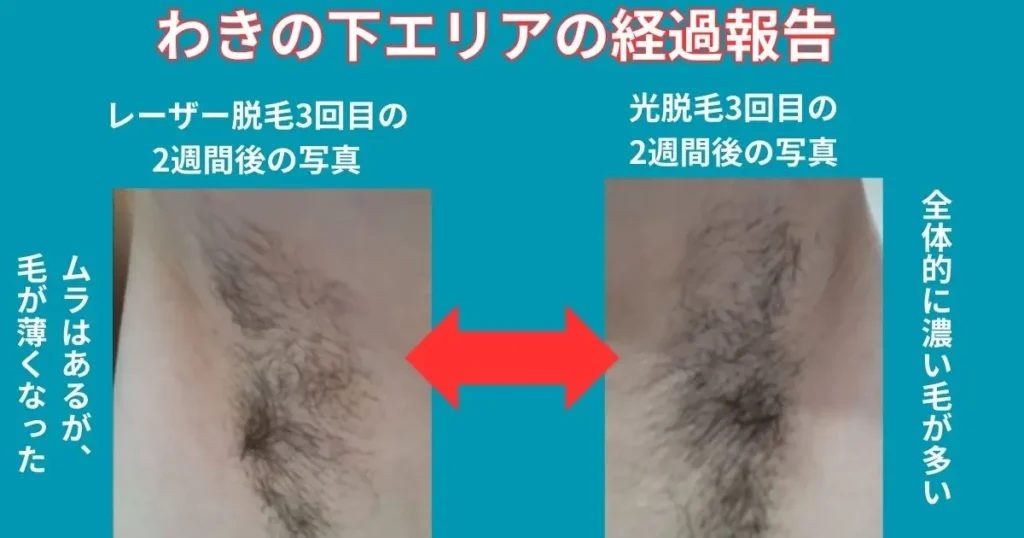 わきの下エリアの経過報告の図解
右わきは、光脱毛のみ3回
左わきは、レーザー脱毛のみ3回
どちらも効果を感じますが
光脱毛のほうが全体的に黒いかんじです。
