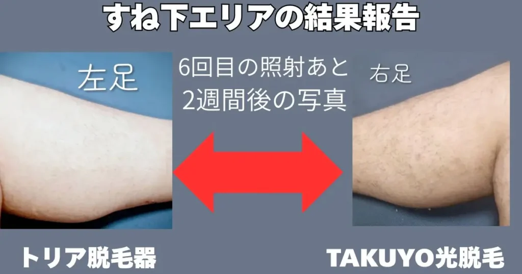 家庭用脱毛器によるセルフ脱毛の6回目の照射報告図解
トリアレーザー脱毛脱とTAKUYO光毛器の比較図解。
明らかにレーザー脱毛した左足のほうが効果が出てます