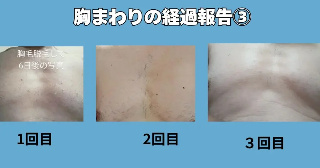 胸まわりエリアの経過写真
