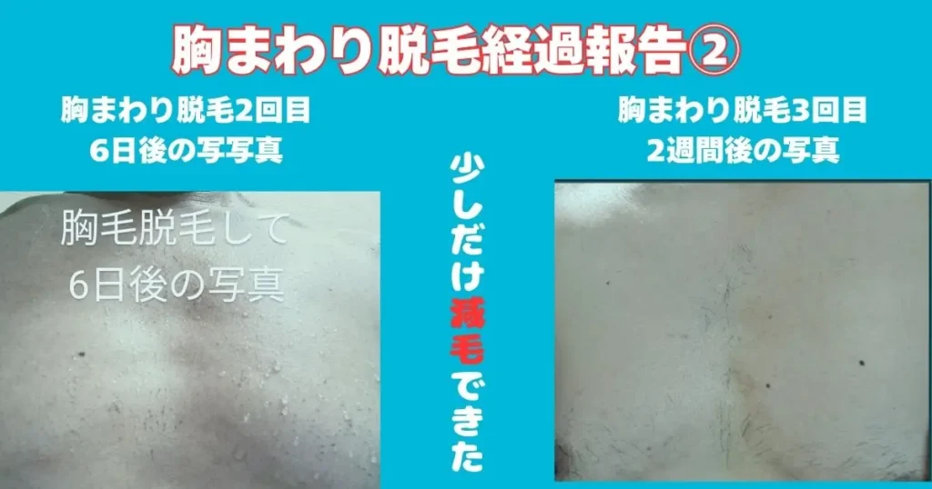 胸まわりの脱毛経過報告の写真入り図解