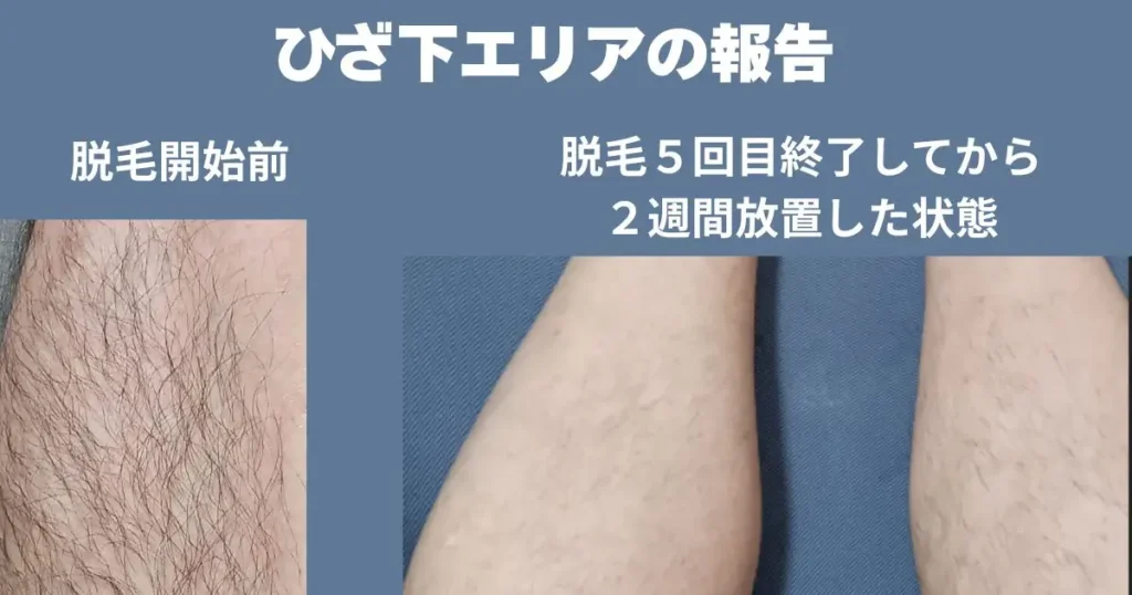 ひざ下エリアの5回目照射してから2週間後の写真。左側は、レーザー脱毛。右側が、光脱毛の写真。