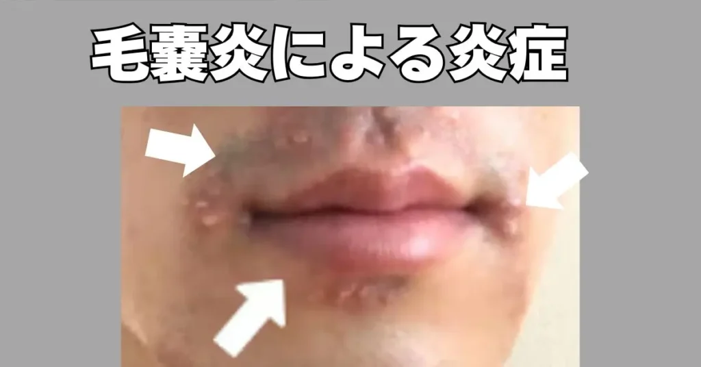 セルフ脱毛でヒゲ脱毛したときのリスク。
毛嚢炎の写真