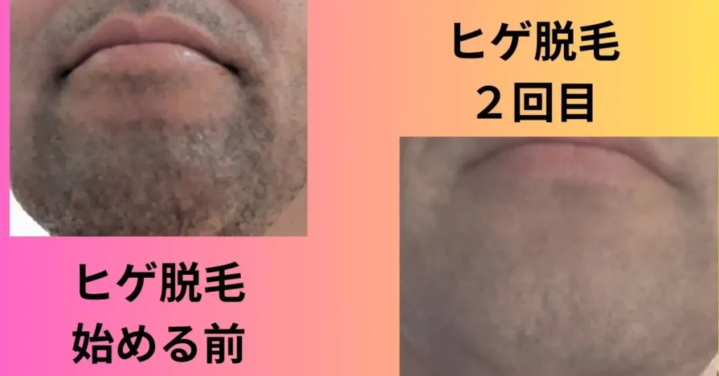 ヒゲ脱毛の開始前の写真と2回目の照射後の比較写真