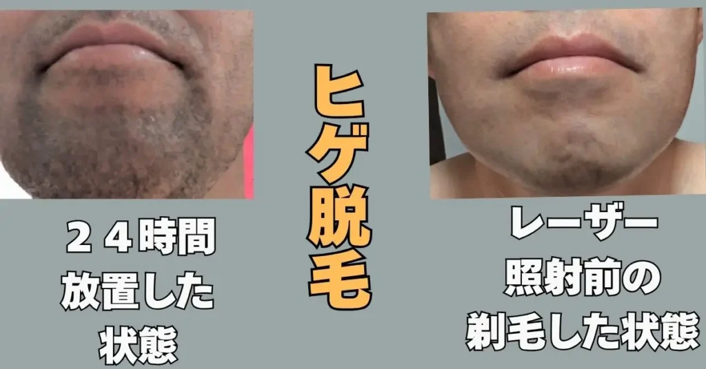 24時間髭を剃らなかったときと
剃毛した後の写真
まだ、ヒゲ脱毛を始める前の写真