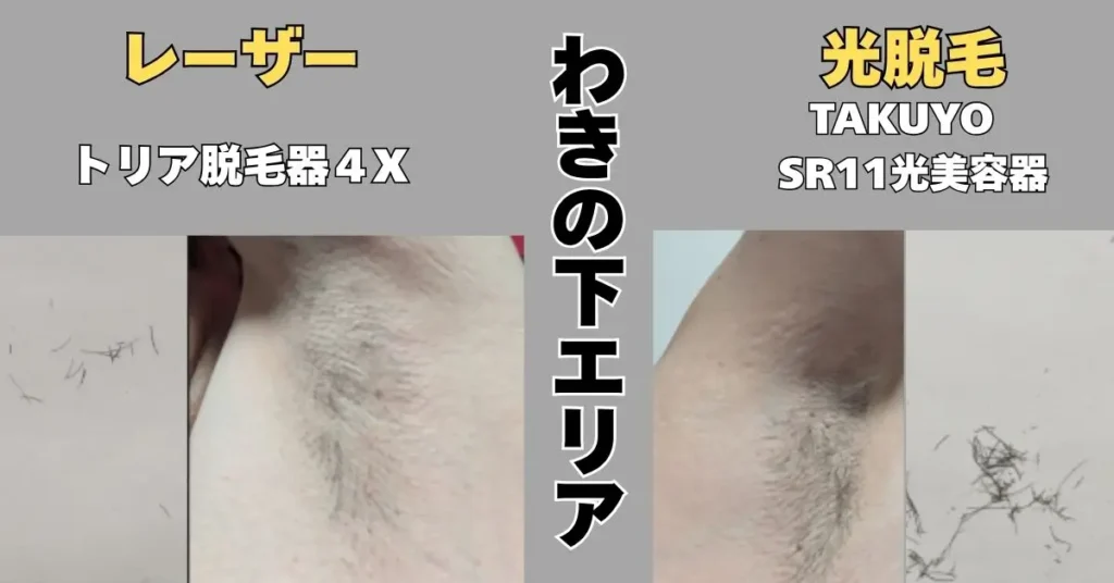 6回目のわきの下エリアの照射写真。
トリアのレーザー脱毛とTAKUYO光脱毛の比較写真