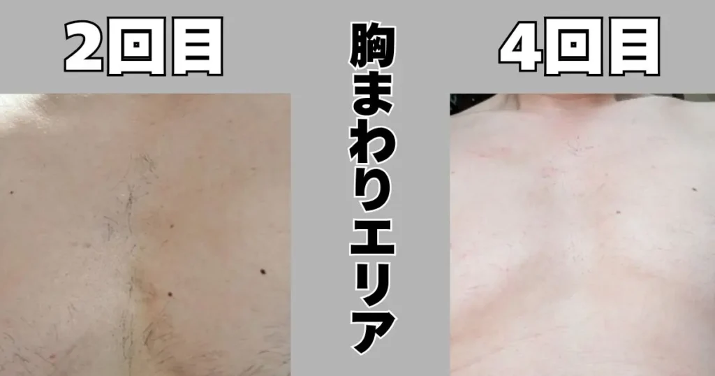 胸まわりエリアの2回目と4回目の比較写真