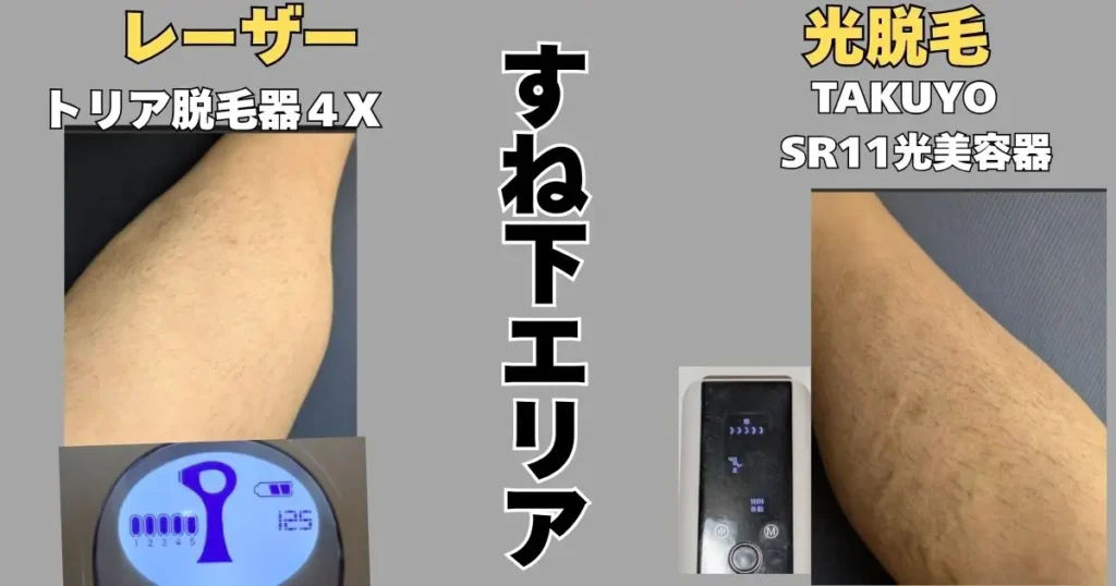 すね下エリアのレーザー脱毛と光脱毛の比較写真