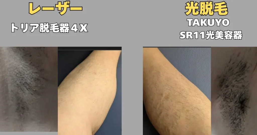 レーザー脱毛と光脱毛のすね下エリアとわきの下エリアの比較写真報告