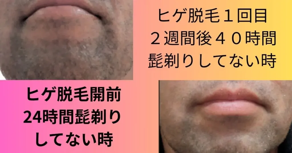 ヒゲ脱毛の前の24時間放置した状態の口回りの写真と1回目の照射した後の40時間報知した状況の写真