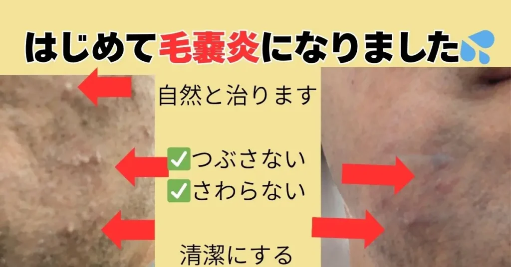 毛嚢炎になりました。
その時の写真の図解