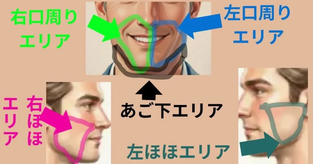 ヒゲ脱毛のエリア分け図解
