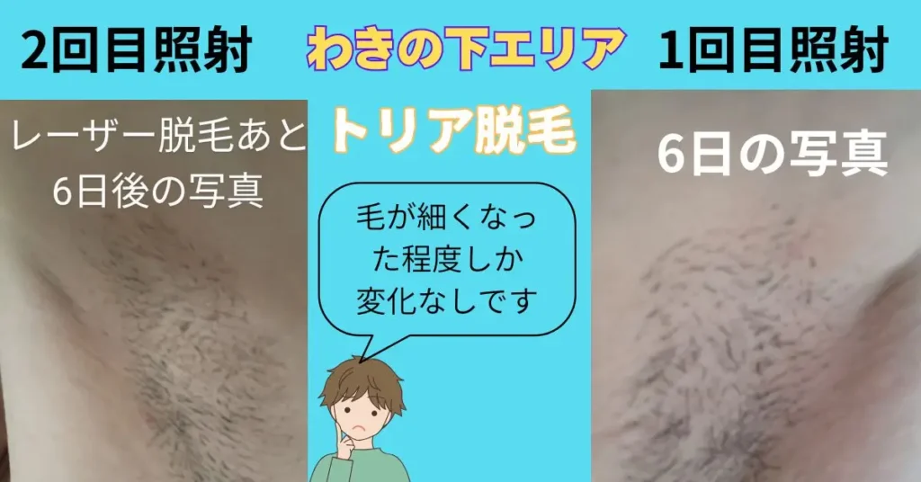 2回目の照射直前の様子。剃毛後の毛の断面が見えている状態。