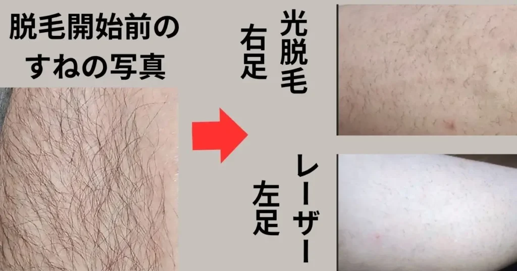 脱毛開始前と９回目の脱毛後２週間経過した写真。
右足は、光脱毛
左足は、トリアレーザー脱毛