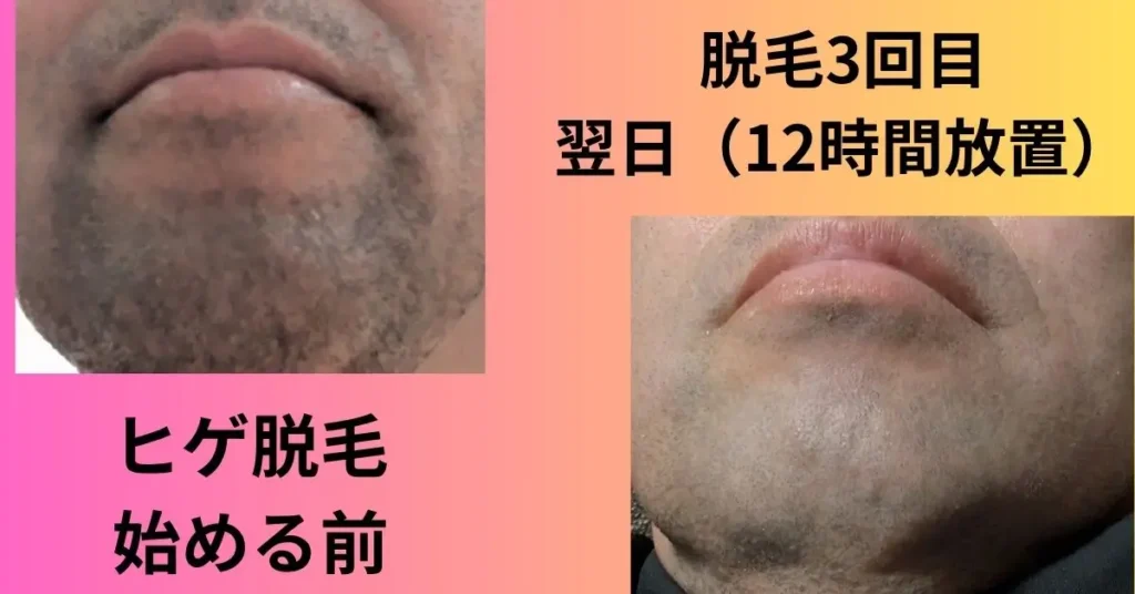 ヒゲ脱毛の比較写真
ヒゲ脱毛開始前（24時間放置）
とヒゲ脱毛3回目（12時間放置）
の比較写真