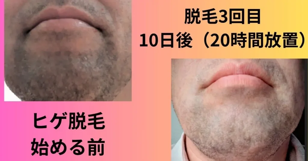 ヒゲ脱毛始める前(12時間放置)
と3回目照射10日後(20時間後放置の比較写真)