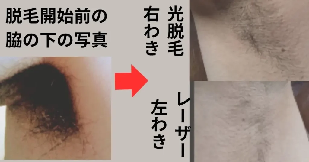 7回目照射直後のきれいな状態と、開始前の比較。