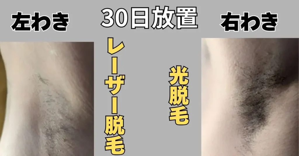 7回目照射から30日間放置したあとの左右比較写真。明らかに左(レーザー)の方が薄い。