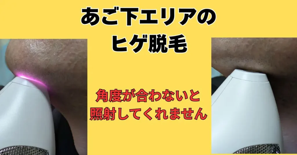 あご下エリアのヒゲ脱毛の照射時のリアル写真