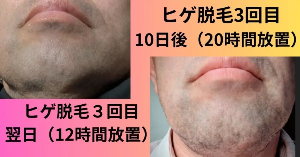 ヒゲ脱毛3回目の照射翌日()12時間放置と10日後(20時間後)の比較写真