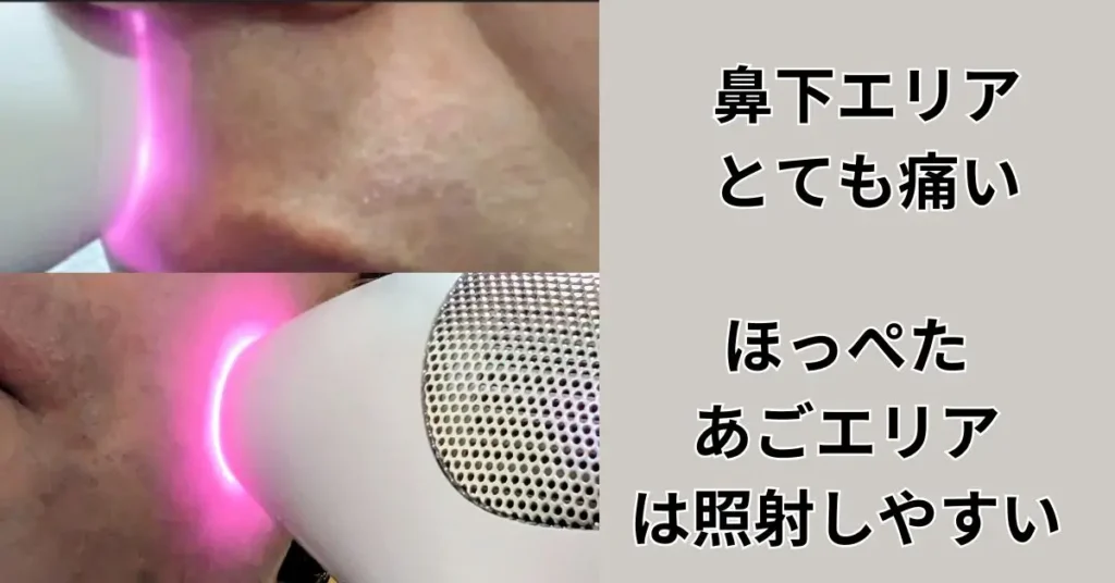 ヒゲ脱毛の鼻下エリアとほほエリアの照射写真
