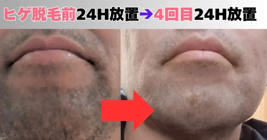 ヒゲ脱毛の24時間放置写真と4回目の24時放置した写真の比較写真