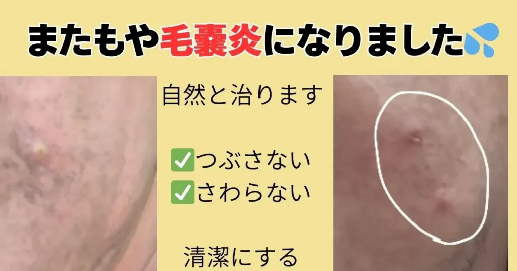 2回目、毛嚢炎になった
写真。