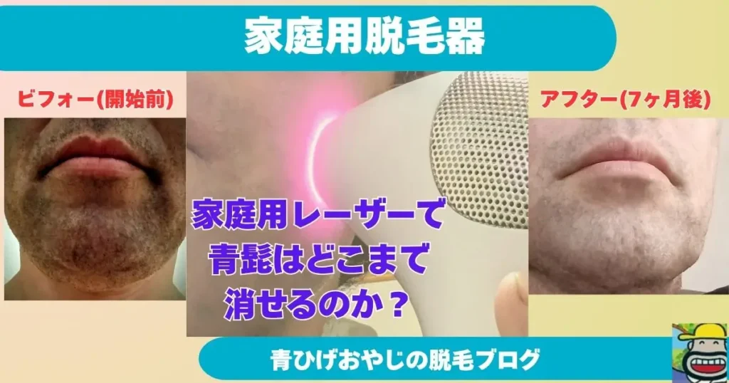 トリアで青髭が消えるのか？剛毛男が7ヶ月ガチ検証して分かったリアルな効果と限界
