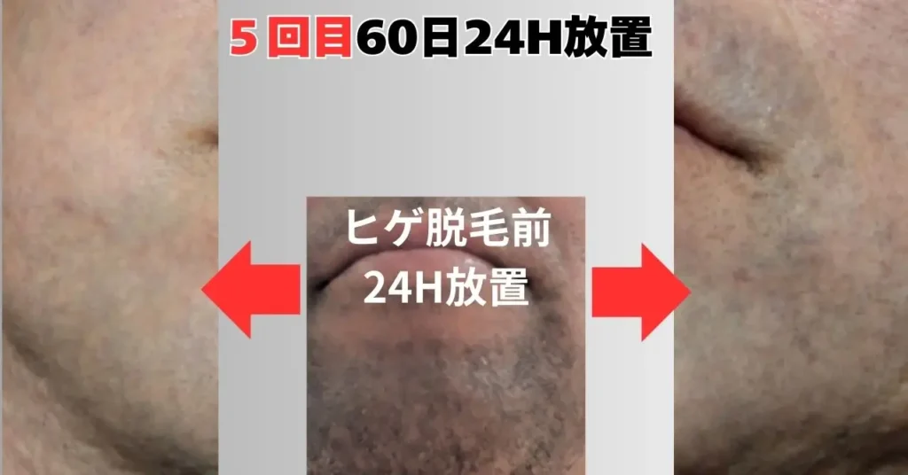 5回目トリアパーソナルレーザー脱毛器照射後60日経過
(24H前に剃毛)