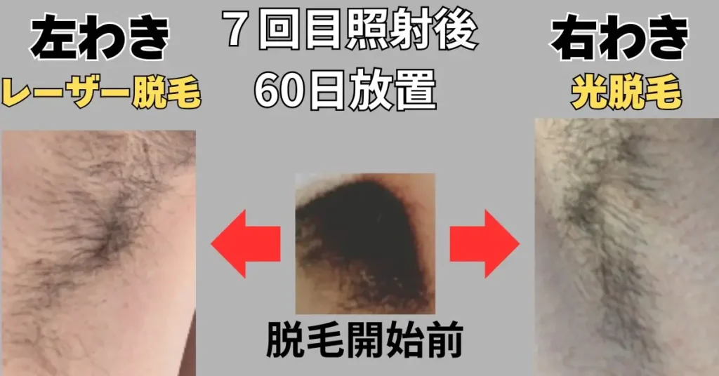 わき毛脱毛7回目照射後 60日放置の写真入り図解