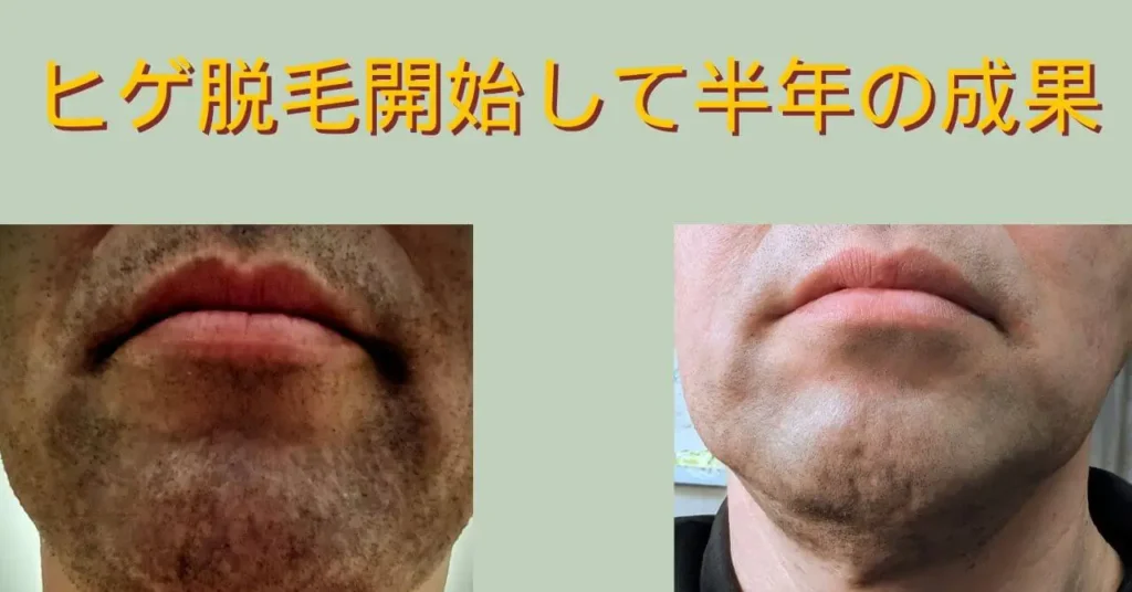ヒゲ脱毛開始して半年の比較写真 (1)