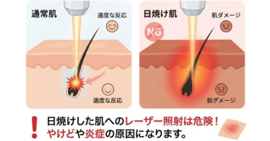 日焼けした肌に脱毛が危険な理由