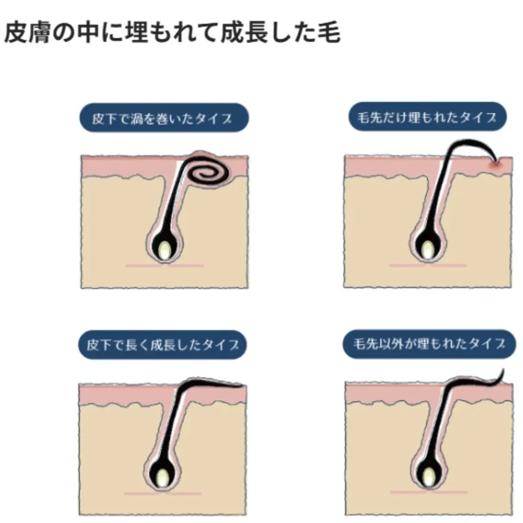 埋もれ髭(埋没毛)のイラスト図解