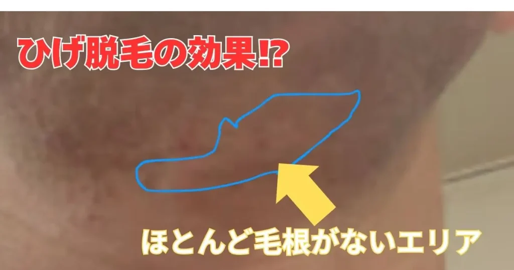 毛根がないエリアの写真